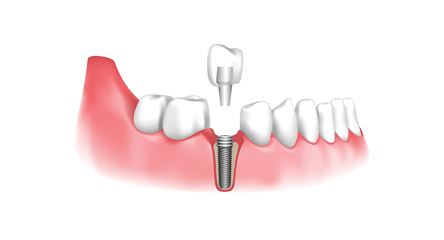 Dental Implants